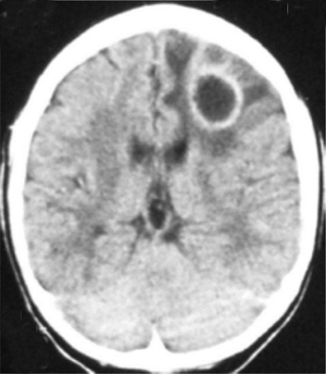 Ring enhancing lesion on CT.png